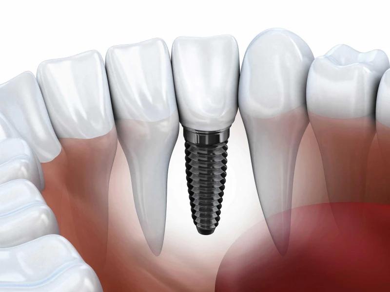 Get the Best Dental Implants at Mesa Dental!