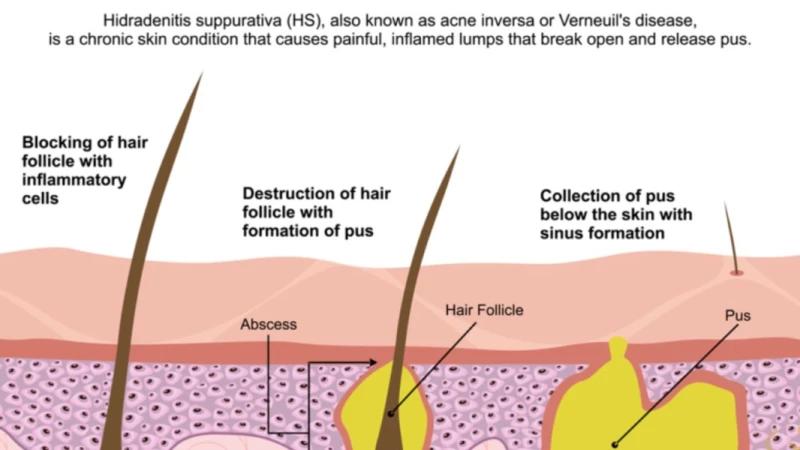 Hidradenitis Suppurativa